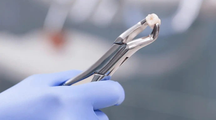 Dental forceps in use during a tooth extraction surgery